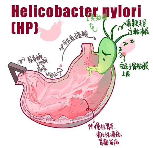 幽门螺旋杆菌